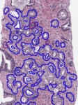 Digital pathology in AI being used as a QC check, with tumor circled